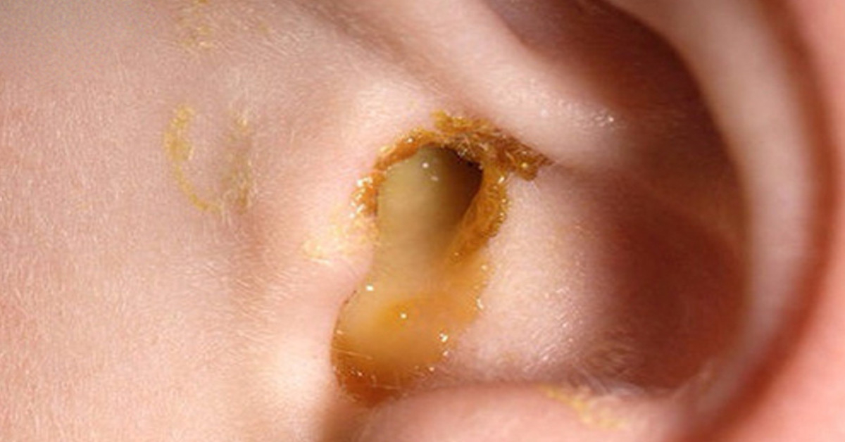Bệnh nhiễm trùng tai phổ biến ở trẻ